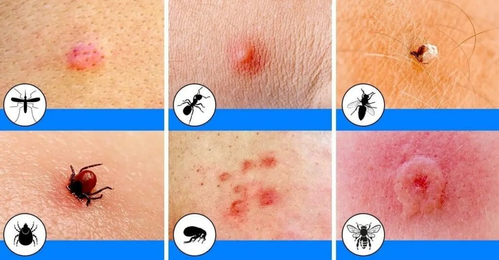 12 piqûres d’insectes communes et comment reconnaître chacune d’elles — free download